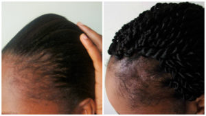 90 day castor oil challenge - 1 month update