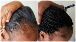 90 day castor oil challenge - 1 month update